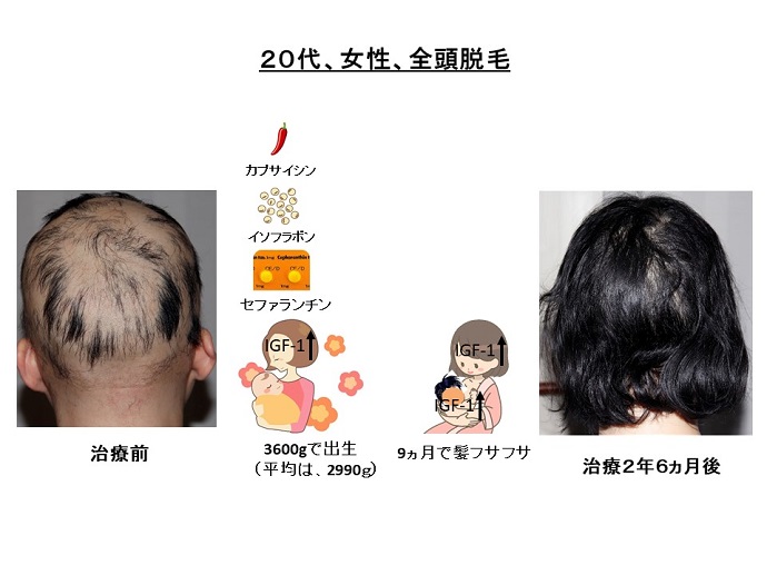 円形脱毛症　名医